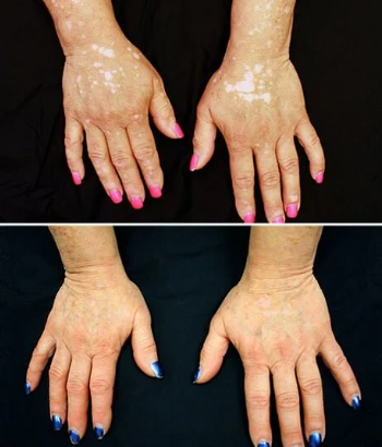 micropigmentacao-vitiligo-copacabana